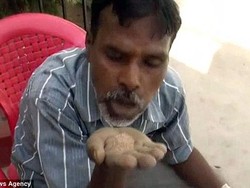 Idap Pica, Pria 45 Tahun Ini Hobi Makan Pasir, Batu Bata dan Kerikil