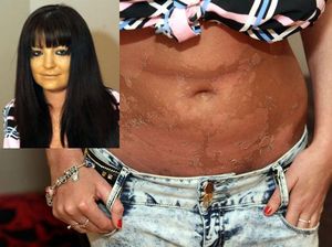 Ingin Kulit Lebih Gelap dengan Tanning, Perut Model Ini Malah Melepuh