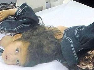 Anak Kembar Dempet Tengkorak Asal Suriah Ini Siap Dipisahkan