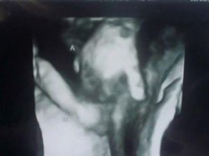 So Sweet! Foto USG Ini Tunjukkan Janin Kembar Bergandengan Tangan