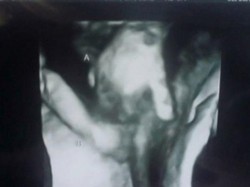 So Sweet! Foto USG Ini Tunjukkan Janin Kembar Bergandengan Tangan