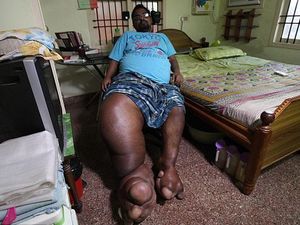 Kaki Pria Ini Bengkak Sebesar Bayi Gajah karena Penyakit Misterius