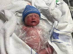 Plastik Sandwich Bantu Bayi Prematur Ini Bertahan Hidup