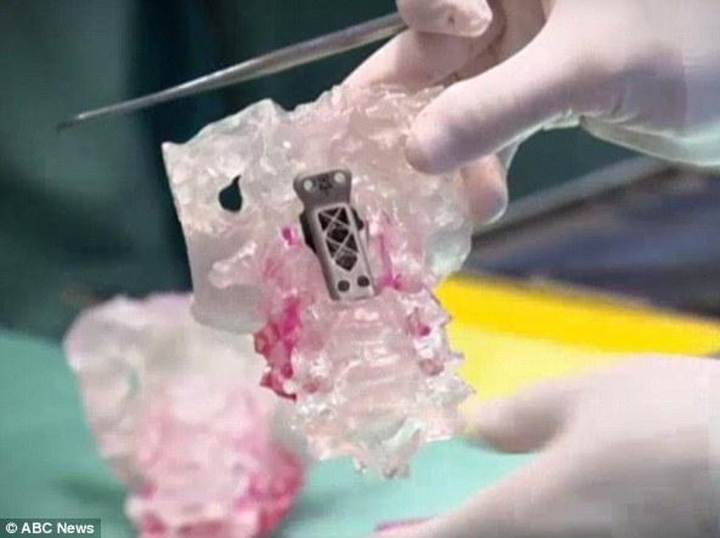 Pertama di Dunia, Tulang Belakang Buatan Sukses Dipasangkan ke Pasien