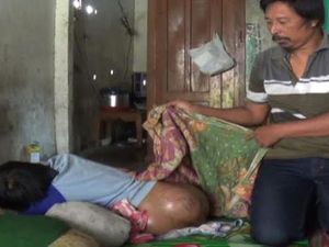 Bocah SD Penderita Tumor Pantat Butuh Uluran Tangan