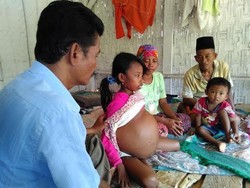 Selama Dua Tahun Nurul Menggendong Tumor Perut 15 Kg