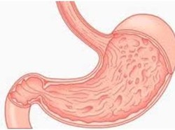 Hindari Makanan Ini Agar Lambung Tetap Sehat