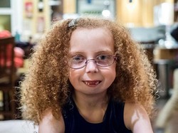 Bocah yang Kesulitan Bernapas Sejak Lahir Karena Lahir Tanpa Rahang