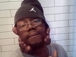 Kisah Keenan, Dijuluki Berkepala Jamur Gara-gara Keloid Besar di Wajahnya