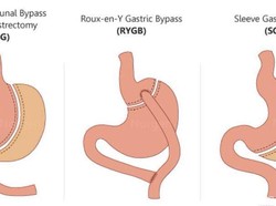 Operasi Penurunan Berat Badan Kurangi Risiko Komplikasi Pasien Diabetes
