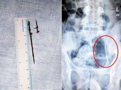 Tangan Mati Rasa, Ternyata Dipicu Dua Jarum yang Nyangkut di Tubuh