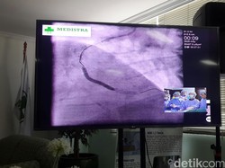 Saat Dokter Indonesia Demonstrasikan Pemasangan Stent Jantung Secara Live