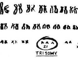 Dokter: Anak Down Syndrome Bisa Dideteksi Sejak dalam Kandungan