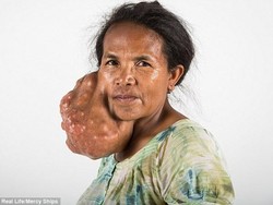 Setelah 14 Tahun, Tumor Seberat Hampir 5 Kg di Wajah Guru Ini Bisa Diangkat