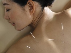 Studi: Terapi Akupunktur Bisa Bantu Cegah Migrain Berulang