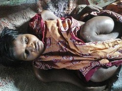 Penyakit Tulang Rapuh Bikin Tubuh Gadis 25 Tahun Ini Seperti Anak-anak