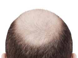 Ternyata Ini Penyebab Anak Muda Alami Kebotakan