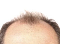 Rutin Konsumsi Makanan Berbumbu Kari Bisa Atasi Kebotakan Pria