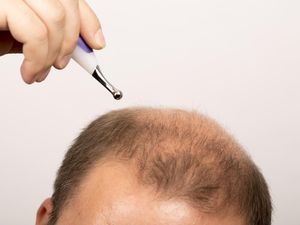 4 Terapi Ilmiah yang Terbukti Bisa Mencegah Kebotakan