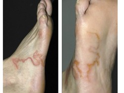 Hii! Dikira Varises, Ruam Merah di Kaki Pria Ini Ternyata Cacing Hidup