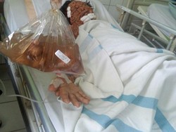 Dibantu Relawan Tantowi, Pak Urip yang Penuh Benjolan Akhirnya Dioperasi