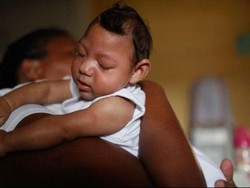 Kasus Mikrosefali Terkait Zika di Brazil Stabil di Angka 4.908