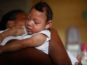 Dugaan Kerusakan Mata Pada Bayi Terkait Zika Makin Menguat Dugaan Kerusakan Mata Pada Bayi Terkait Zika Makin Menguat