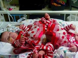 Bayi Kembar Dempet Pinggul yang Langka Asal AS Akhirnya Terpisahkan