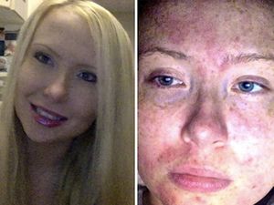 Terlalu Sensitif, Kulit Gatal-gatal Hanya karena Keringat dan Air Mata