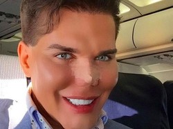 50 Kali Operasi Plastik, Pria Mirip Ken Barbie Ini Kesulitan Bernapas