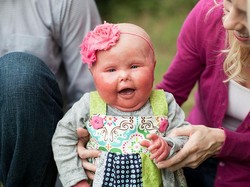 Isi Hati Ibu Seorang Anak yang Kulitnya Mengelupas karena Kelainan Genetik