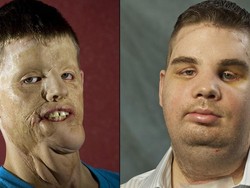 Kisah Hunter, Kembali Pede Setelah Hampir 10 Tahun Berwajah Tak Sempurna