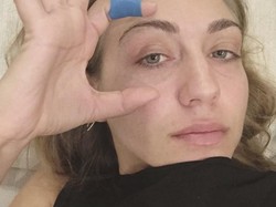 Chloe Pernah Tak Berhenti Haid Selama 5 Tahun karena Kelainan Genetik