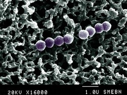 5 Tanda Pneumonia yang Kerap Disangka Penyakit Flu