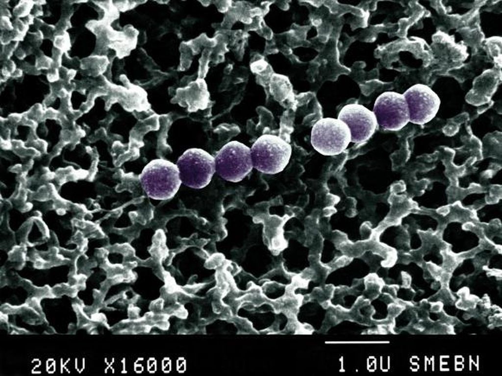 5 Tanda Pneumonia yang Kerap Disangka Penyakit Flu 5 Tanda Pneumonia yang Kerap Disangka Penyakit Flu