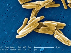 Lockdown Global Corona Bisa Memicu Lonjakan Kematian karena TBC