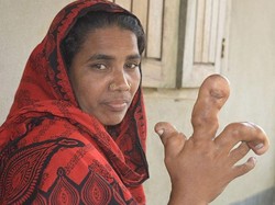Wanita di Bangladesh Ini Punya Jari Raksasa, Penyebabnya Masih Misterius
