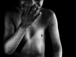 Penyakit Langka Bikin Bocah Ini Sering Menyakiti Diri Sendiri