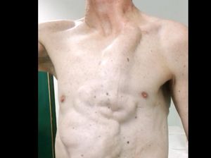 Kasus Langka, Kerongkongan Pria Ini Terlihat Menonjol di Balik Kulit