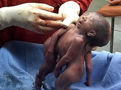 Tragis, Kembar Siam Ini Terlahir dengan Berbagi Wajah