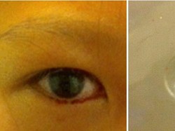 Ada Darah di Air Mata, Ternyata karena Lensa Kontak yang Bersarang 2 Tahun