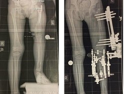 Balita Ini Kakinya Panjang Sebelah, Dipatahkan 300 Kali untuk Menyamakannya