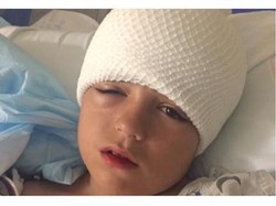 Jatuh dari Sepeda Saat Tak Pakai Helm, Bocah Ini Alami Cedera Kepala Parah