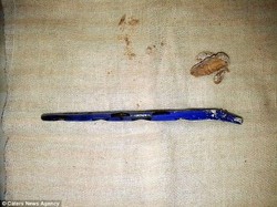 Sikat Gigi Tertelan, Setahun Lamanya Bocah Ini Menahan Sakit Perut