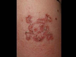 Pakai Henna Hitam, Bocah 10 Tahun Ini Alami Alergi Kulit Parah