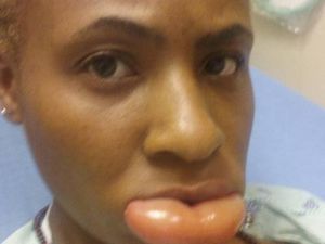 Alergi Lipstik, Bibir Wanita Ini Jadi Super Bengkak