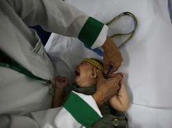 Studi: Terinfeksi Zika di Trimester Pertama Perbesar Risiko Bayi Mikrosefali