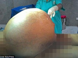 Perempuan Ini Hidup dengan Kanker Seberat Anak Gajah Selama 5 Tahun