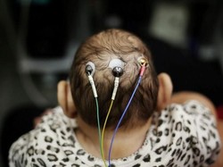 Meksiko Konfirmasi Kasus Mikrosefali Pertama Akibat Zika