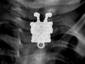 Korek Api Hingga Ponsel, Benda-benda Tak Lazim yang Pernah Tertelan Manusia